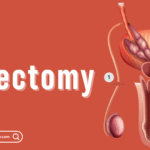 Vasectomy
