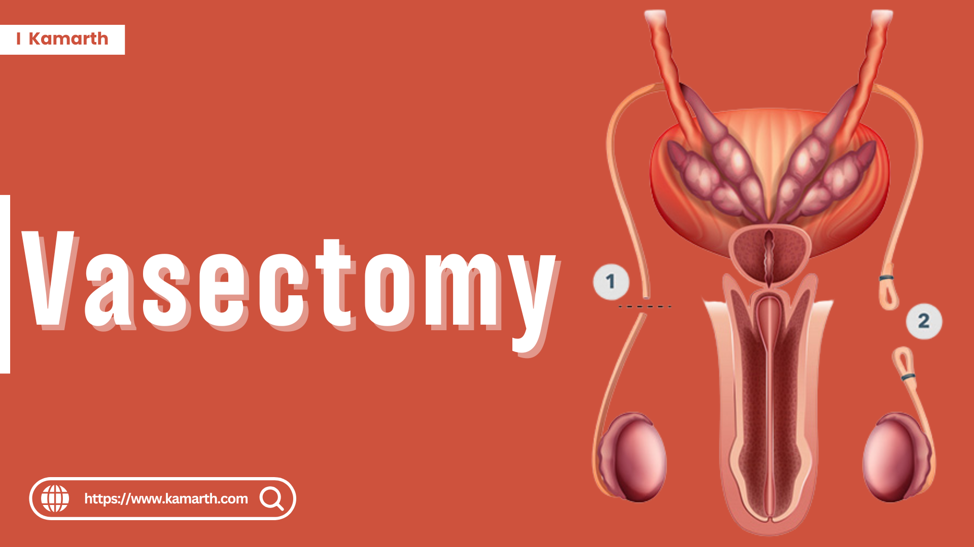 Vasectomy